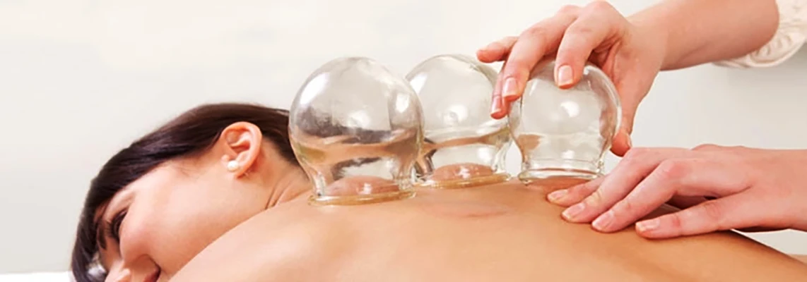 Chiropractic Minneapolis MN Cupping